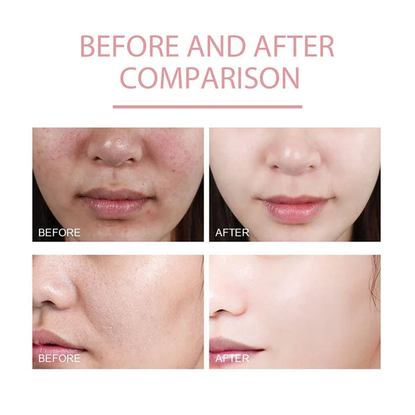 Niacinamide Whitening Facial Essence Remove Acne Marks Dark Spots Moisturizing Repair Shrink Pores Brighten Face Skin Care Serum