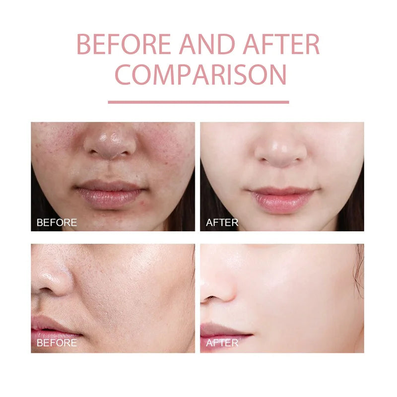 Niacinamide Whitening Facial Essence Remove Acne Marks Dark Spots Moisturizing Repair Shrink Pores Brighten Face Skin Care Serum
