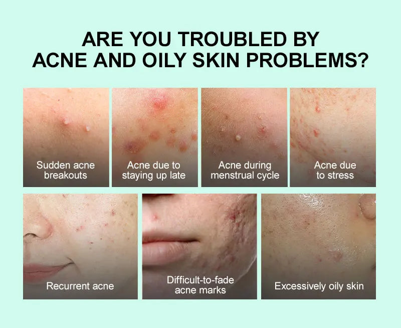 JellyPrim Salicylic Acid Pimple Removal Niacinamide Whitening Facial Serum Shrink Pores Skin Care Cosmetics